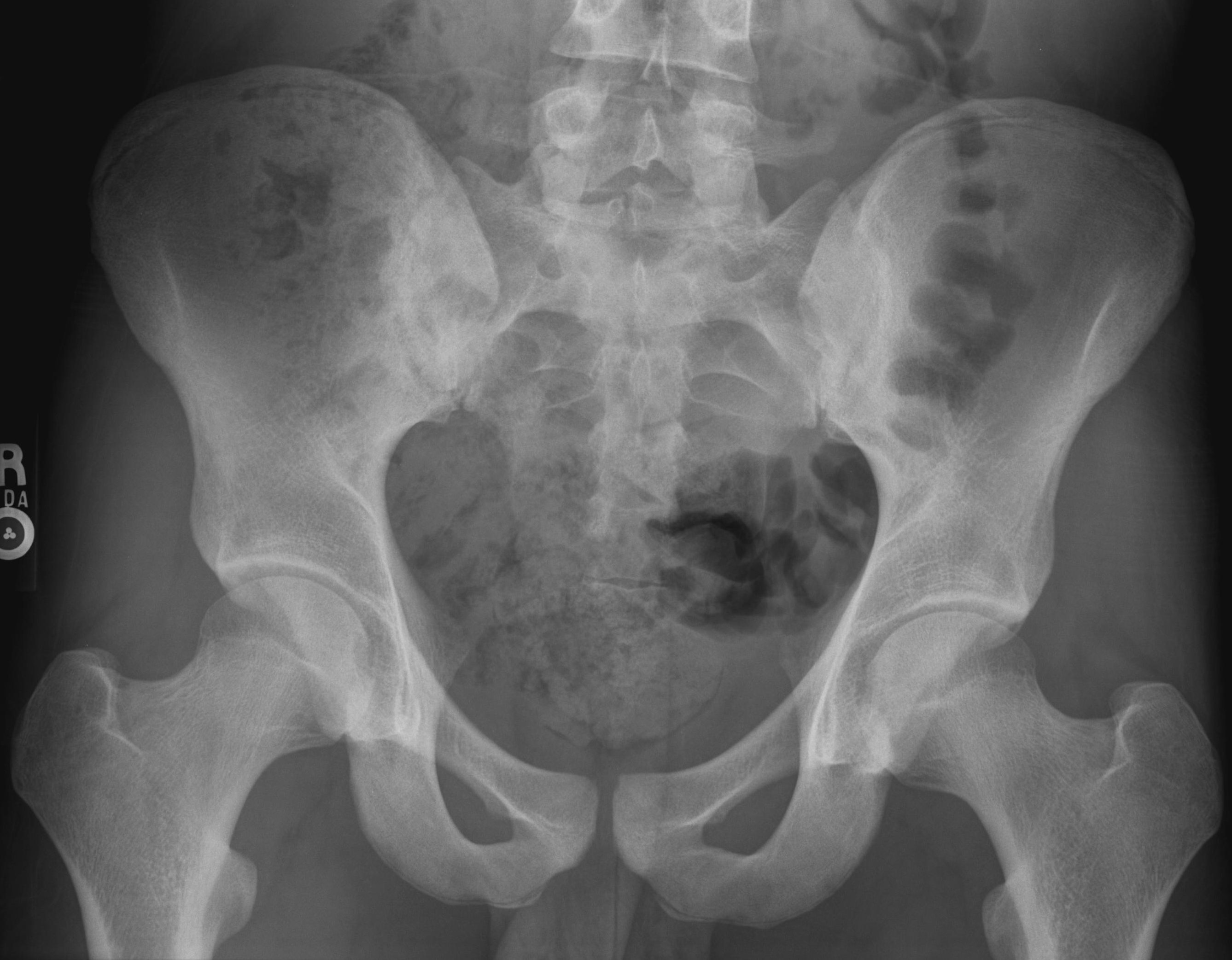 Normal Hip Xray Berryquest normal-hip-xray-berryquest